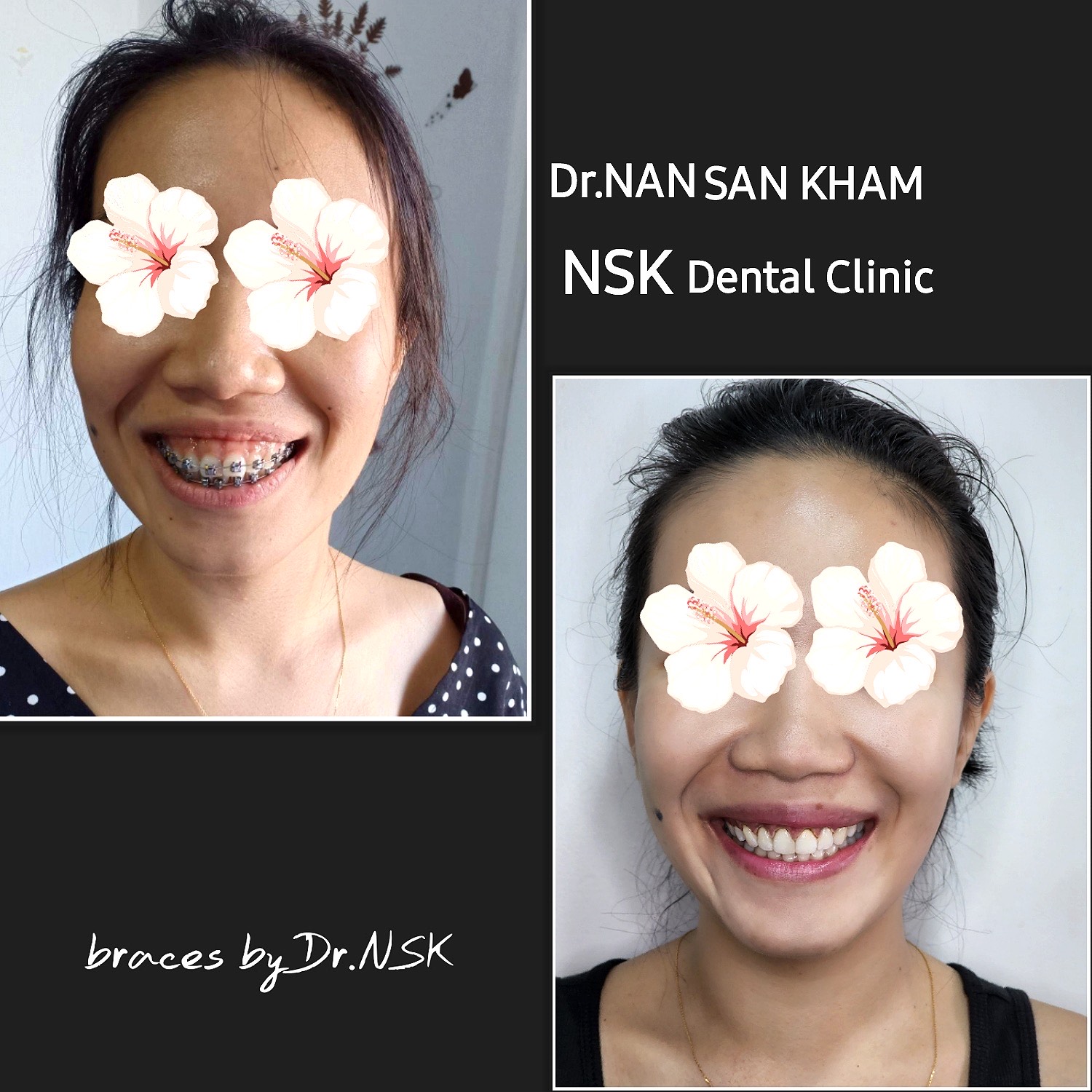 Beneficios del láser dental para pacientes